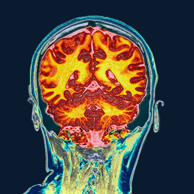 False-colour MRI scan of a head, seen from the front, with the brain glowing orange and yellow